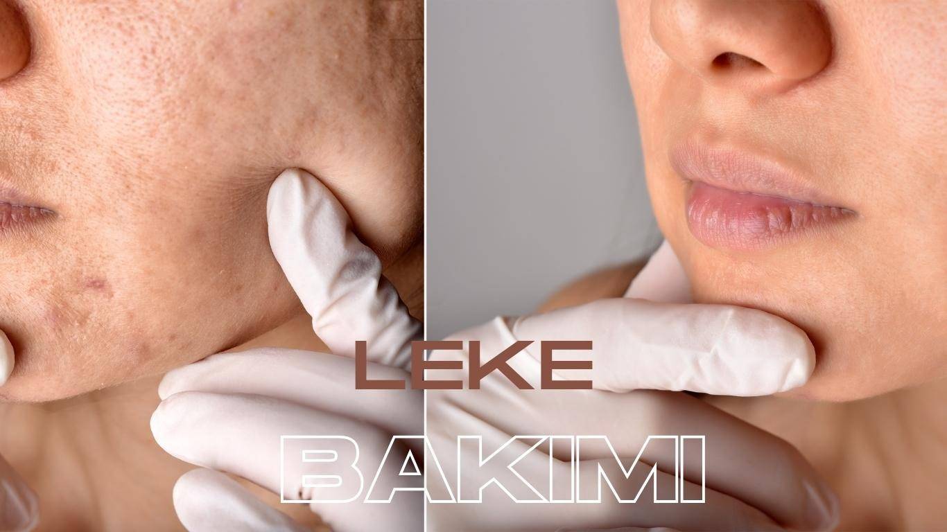 leke bakımı